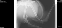 大腿骨の横骨折1