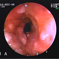 炎症性ポリープによる直腸狭窄1