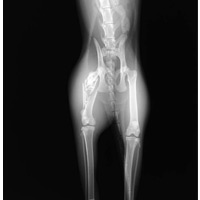 大腿骨骨折（粉砕骨折）1