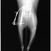 大腿骨骨折（粉砕骨折）2