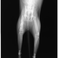 大腿骨骨折（粉砕骨折）3