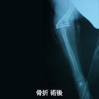 肘関節骨折2