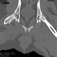 レッグペルテス（大腿骨頭壊死症(レッグペルテス) のCT像）1