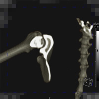 レッグペルテス（大腿骨頭壊死症(レッグペルテス) のCT像）2