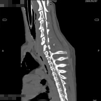 脊髄造影（頸部椎間板ヘルニア(ビーグル)の脊髄造影CT像）2