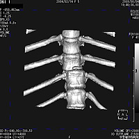 椎体骨折のCT像および整復後のレントゲン像1