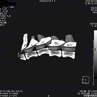 椎体骨折のCT像および整復後のレントゲン像2