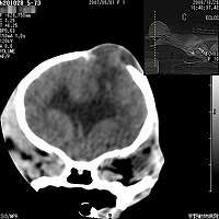 頭部外傷と脳腫瘍