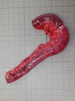 腸間膜裂孔ヘルニア3